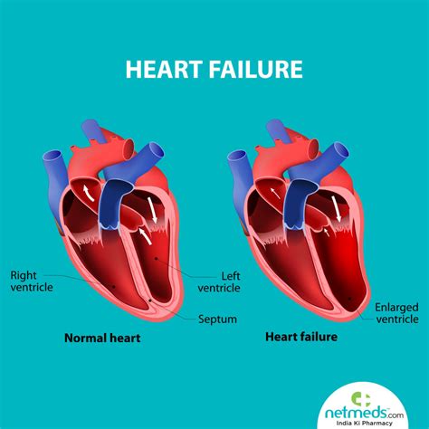 mild lv dysfunction meaning|what is severe lv impairment.